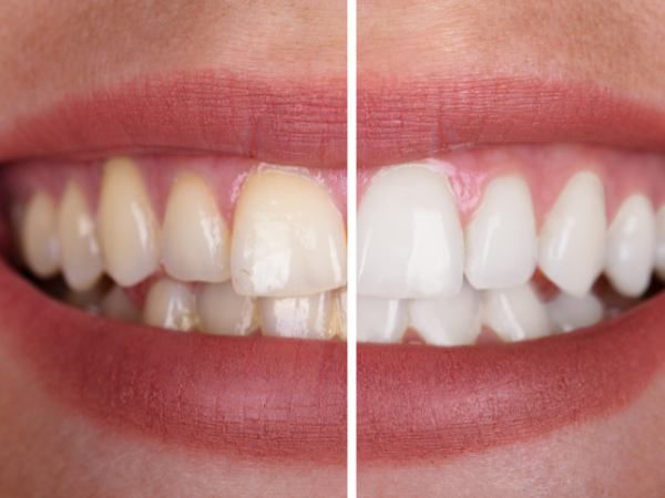 Teeth Whitening & Bleaching