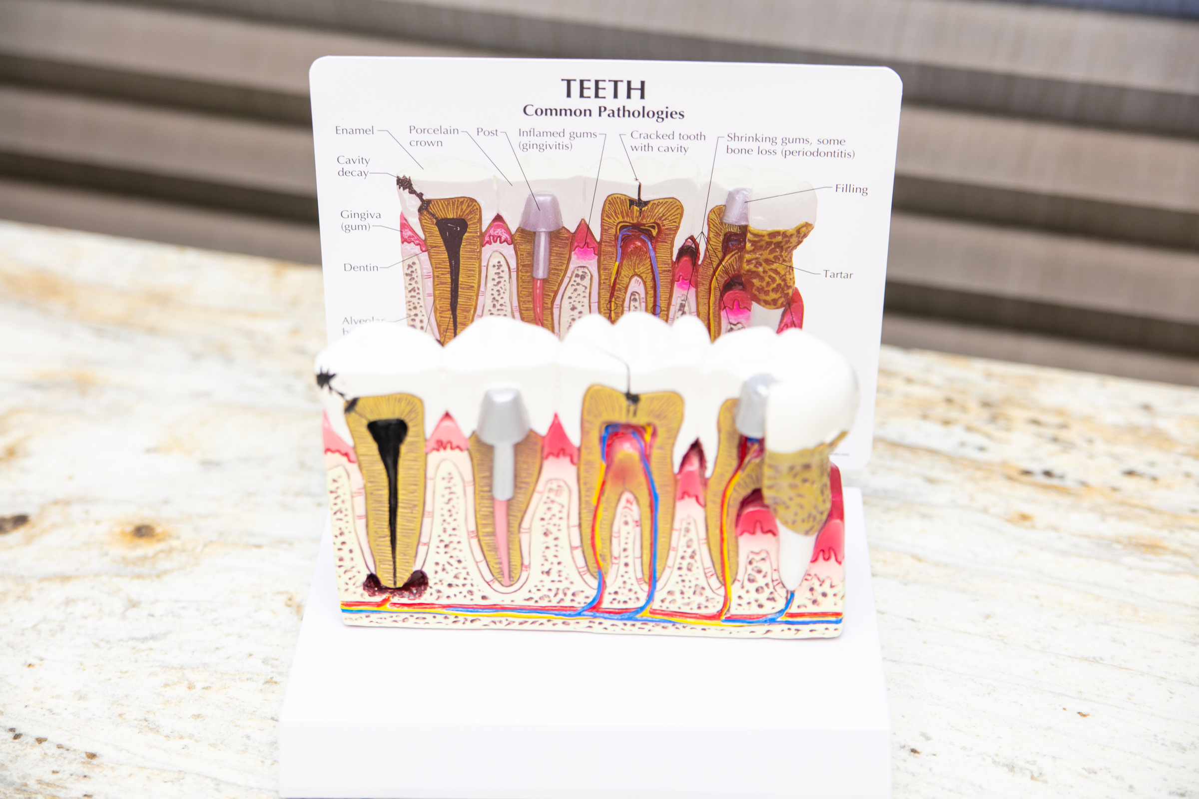 Teeth common Pathologies