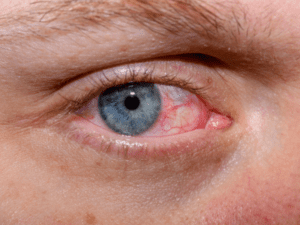 How to Keep Your Eyes Healthy During Allergy Season