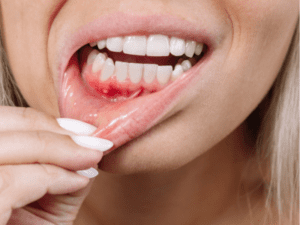 Understanding Gum Disease